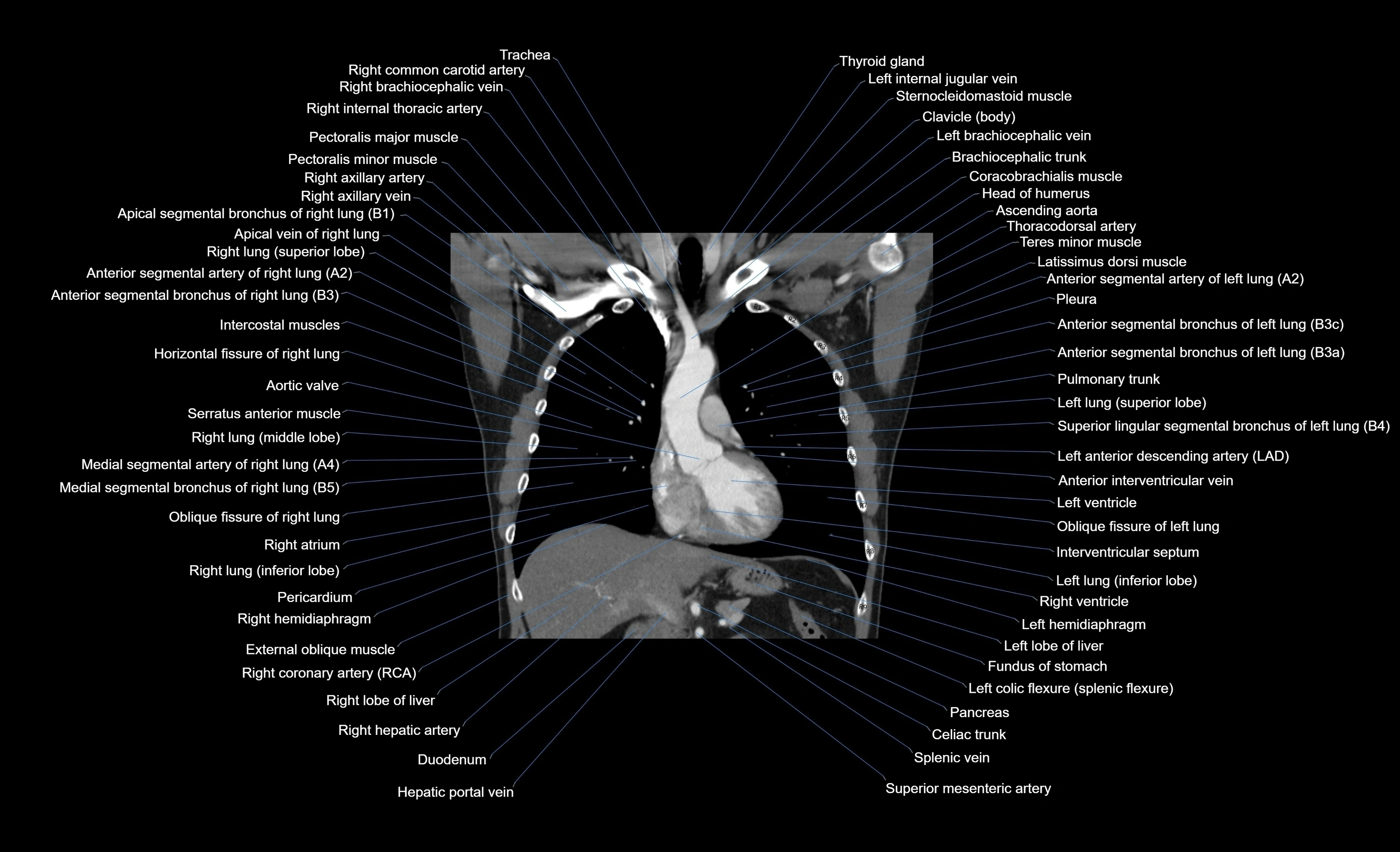 CT chest (thorax) soft tissue window labelled coronal cross sectional anatomy radiology image-00071.webp